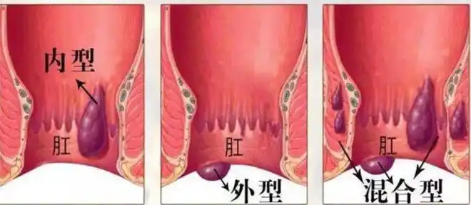 问个悄悄话:你怀孕后有痔疮吗?|便血|水肿|外痔|便秘_网易订阅