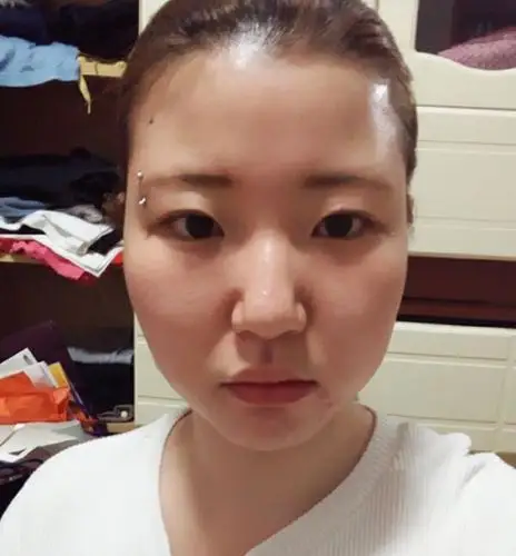 就是想摆脱这个大肉鼻子,所以决定做的鼻子,顺便咨询_圈子-新氧美容