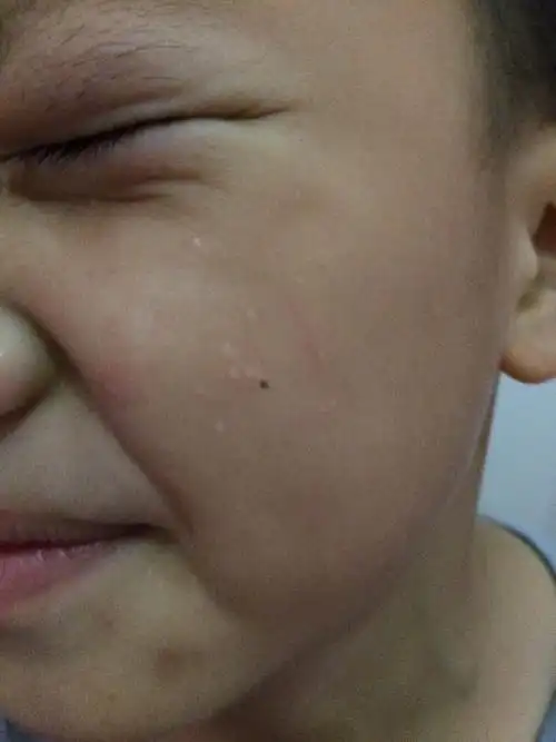 6岁儿童脸上长白色颗粒的是什么