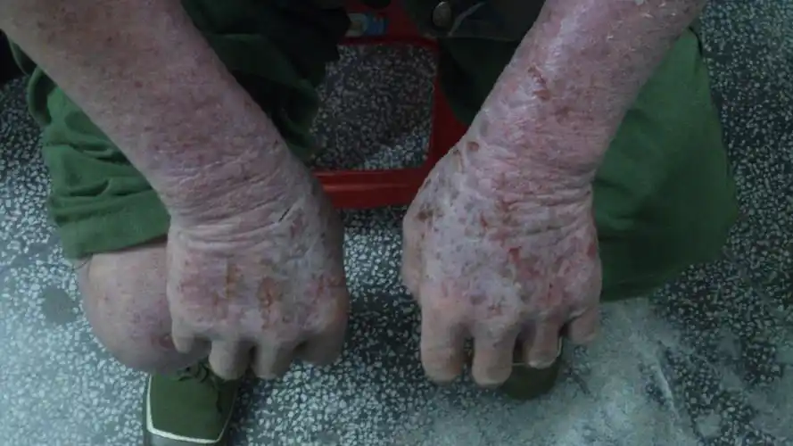 有请皮肤科专家看看这位大爷的皮肤病非常严重