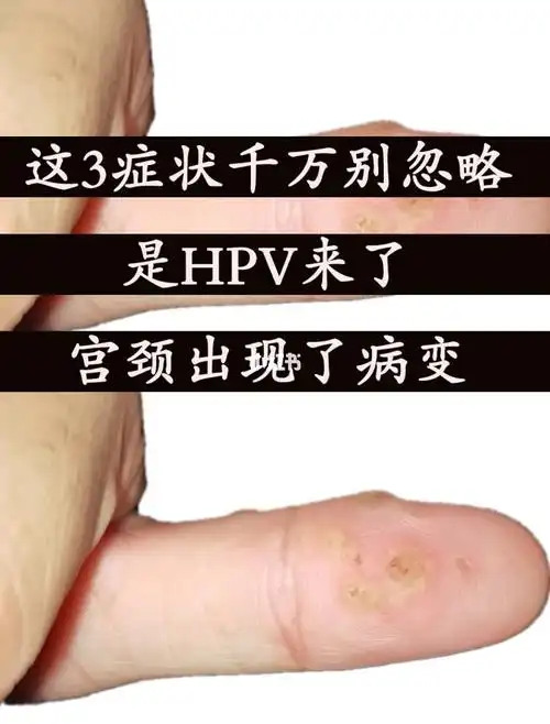 这3症状千万别忽略hpv来了宫颈出现病变