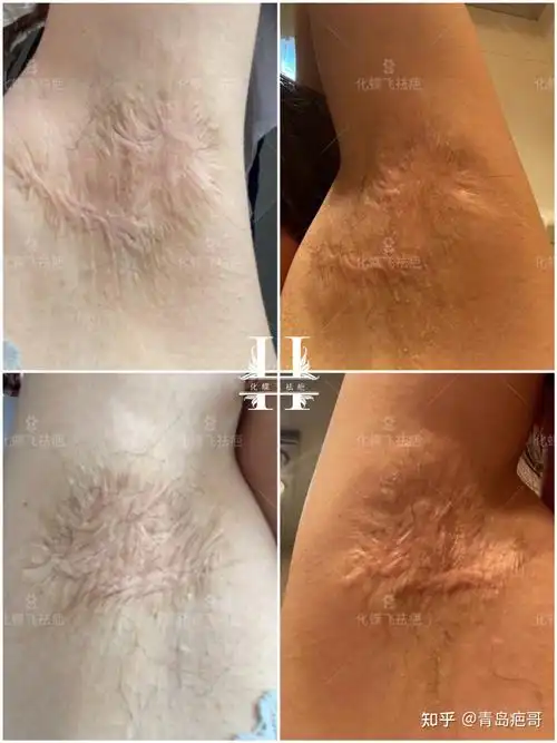 二十多年的腋下手术疤痕