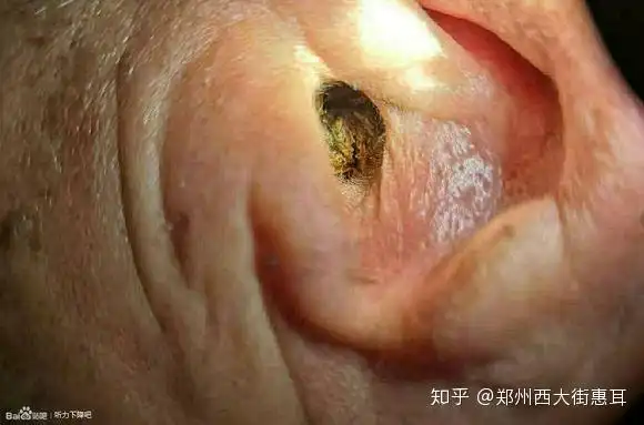 油耳朵和干耳朵有哪些区别油耳朵中的油到底是什么