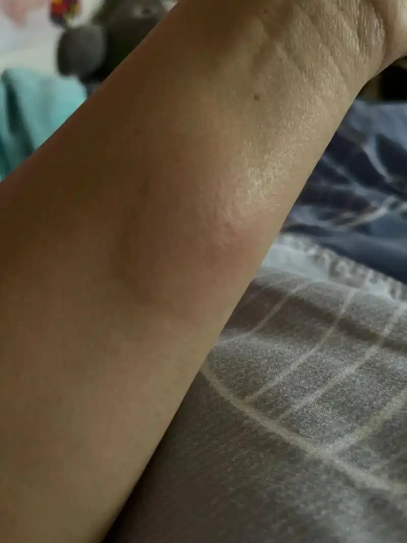 ppd皮试48小时了,好大啊,有点慌,因为以前有个胸膜炎