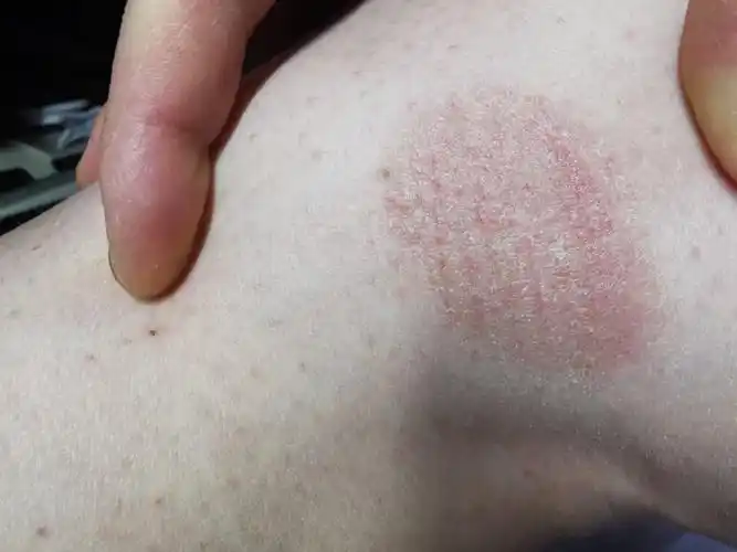 皮肤病,帮忙看下是不是癣,还是其他啥,不痛不痒,半个月了,开始以为是