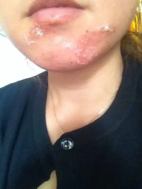 脸上不知道被什么虫粉碰过,红肿发侬,火烧一样