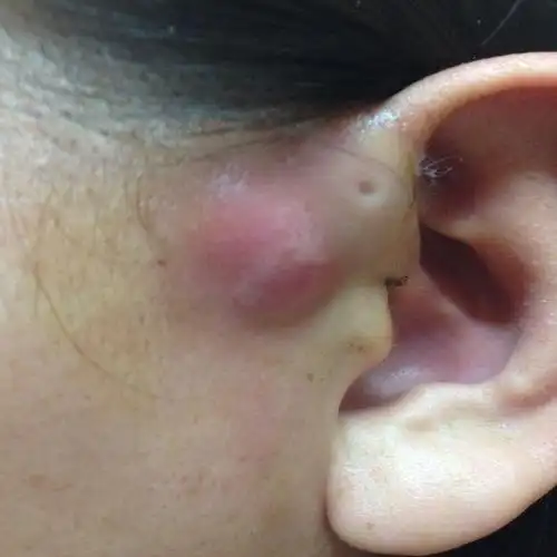 正宗耳前瘘管发肿炎鼓包流脓/流液痒异味臭无痛清脓封口膏 杨柳卿