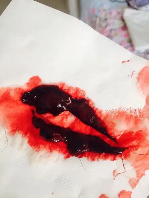 怎么辨别自然流产还是月经?