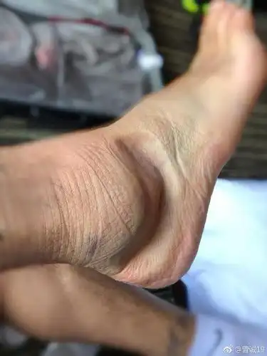 慎点!曾诚复出晒右脚,明显凹陷了一块
