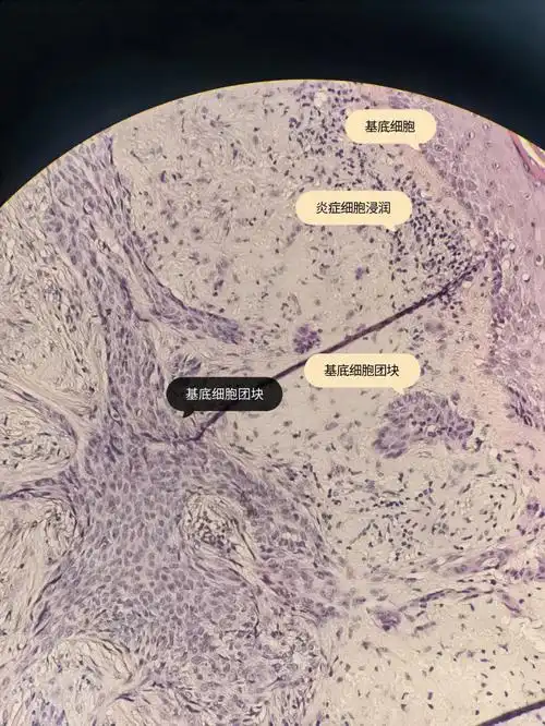 皮肤病理丨基底细胞癌