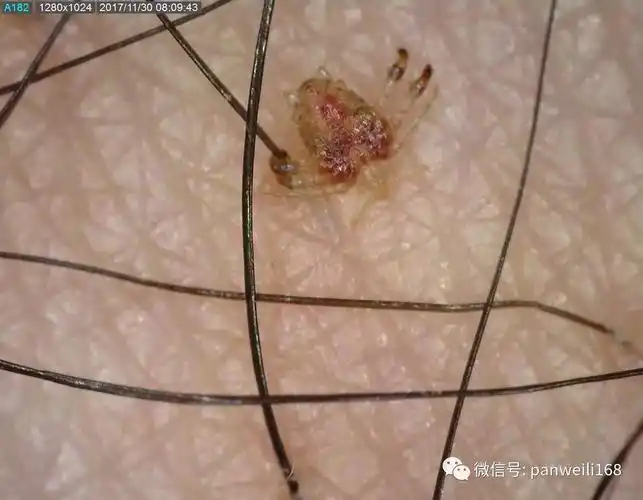 虱子:当心这个会玩单杠双杠的家伙! - 好大夫在线