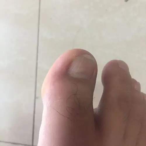 关节处不疼,大脚趾头疼.