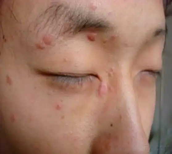 脸上长扁平疣图片