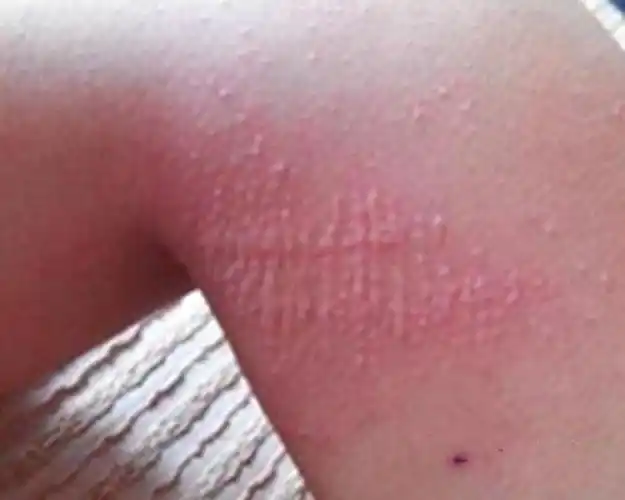 梅毒淋病口腔症状图片