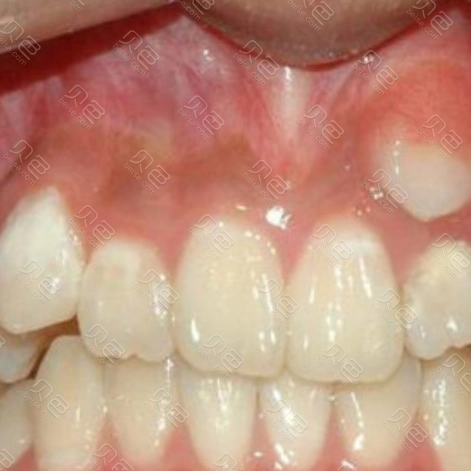 大连卓尔美笑口腔(海滨路店)多生牙矫正案例