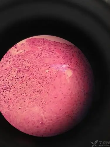 在病理规培中,这个高分化鳞癌的异型程度就这样的吗?