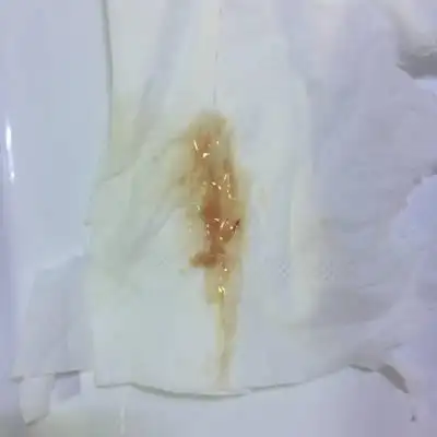 我是11月26号来的最后一次月经,这两天尿完后一直有带血丝的褐色分泌