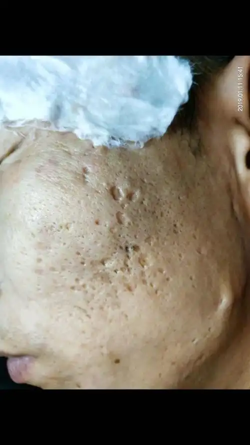 严重的痘坑操作一次五天的效果对比哦!