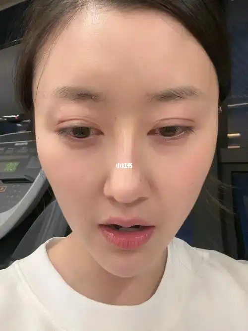 终于我拆掉了埋线双眼皮不再做悲伤蛙了