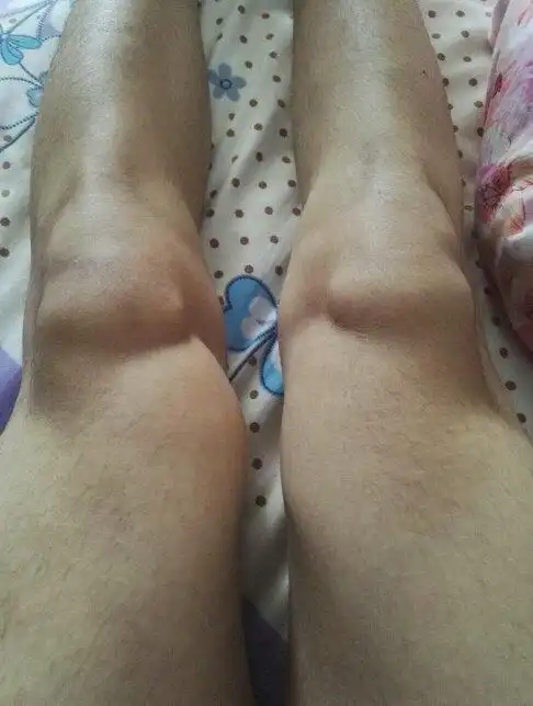 2017-04-29   展开全部 你好,你这种是正常的,我以前也有过膝盖凸起