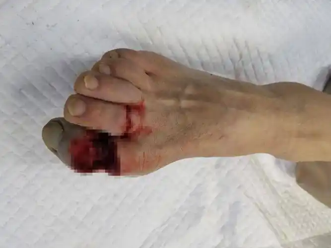 【断趾再植】不慎锯伤脚趾,市七院紧急实施断趾再植术