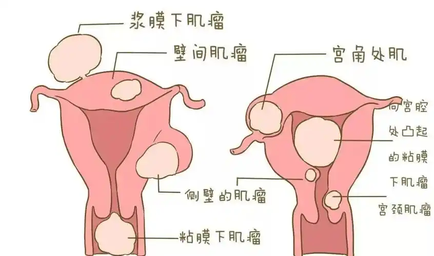 04子宫腺肌症子宫腺肌症一般分布在子宫肌层,会影响到女性的正常生理