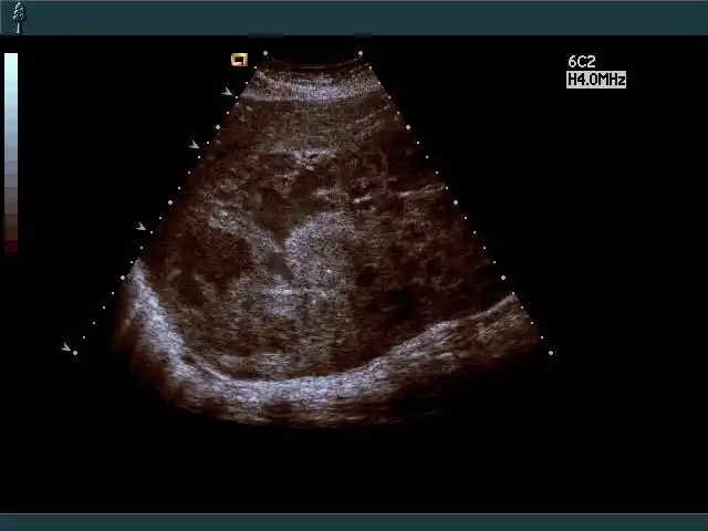 几张超声图片给大家看看