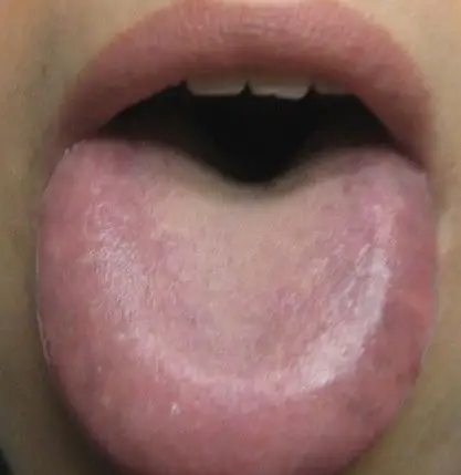 我的舌头两侧有些发紫,舌头肿胖.全身的肉很松软.我知道有些脾虚痰湿.