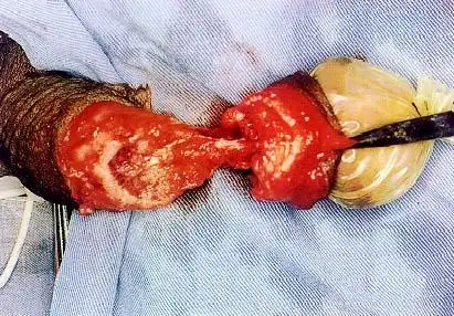 阴茎部分切除术图解手术图解