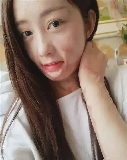 安徽16岁美少女周岩,因拒绝官二代表白被泼汽油毁容,后来怎样了