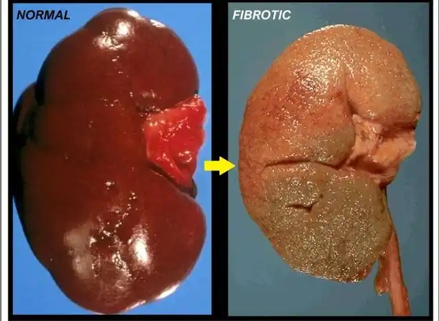 正常肾脏(左图)纤维化的肾脏(右图)