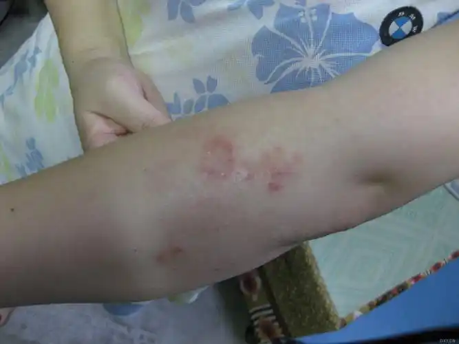 【求助】前臂皮肤红疹瘙痒