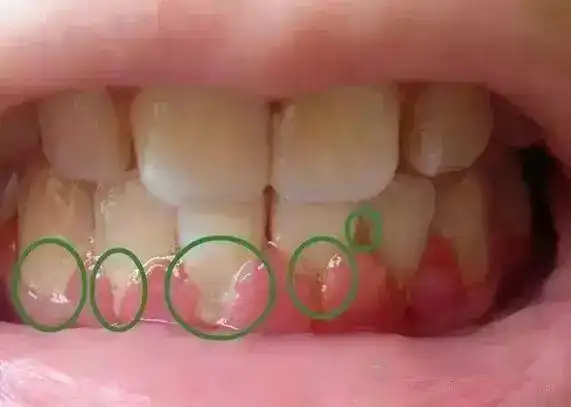 烟渍牙真恶心怎么快速变白