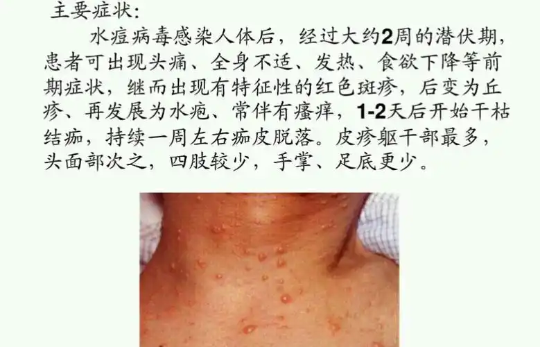 水痘是一种由水痘带状疱疹病毒所引起的急性传染病.