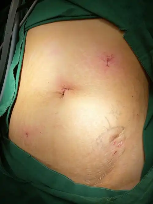 术后腹壁仅留下几个钥匙孔大小小洞,术后疼痛轻,无需拆线