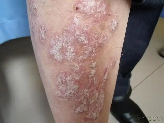 银屑病手背和下肢