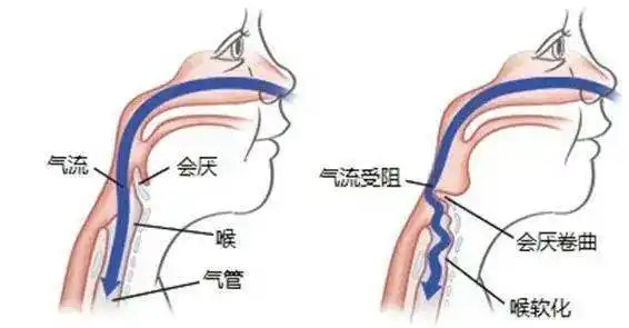 innovitefamilies喉软骨软化症原因年龄分布:以出现临床症状为限