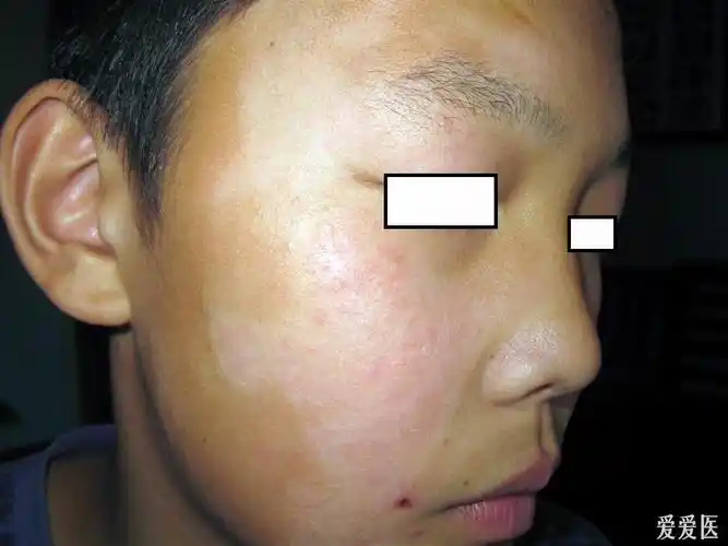 看图识病白色糠疹