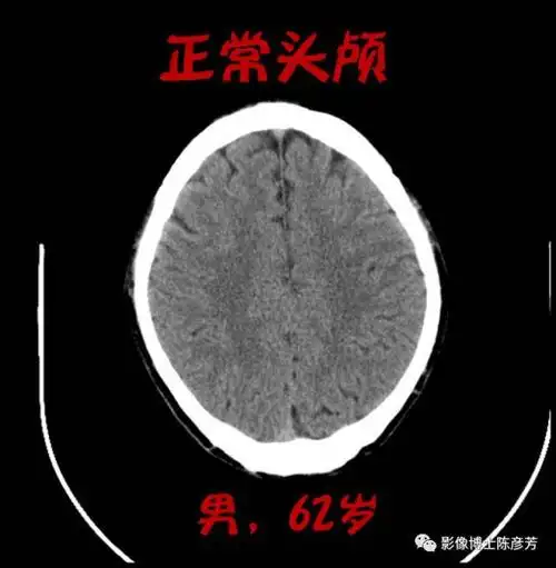 喝酒喝出脑萎缩,不是危言耸听!