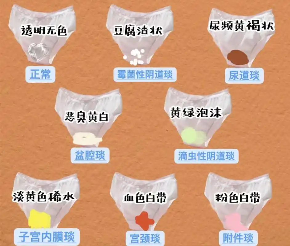白带,女人健康的"晴雨表"  正常情况下,白带呈白色,无气味,量,质会