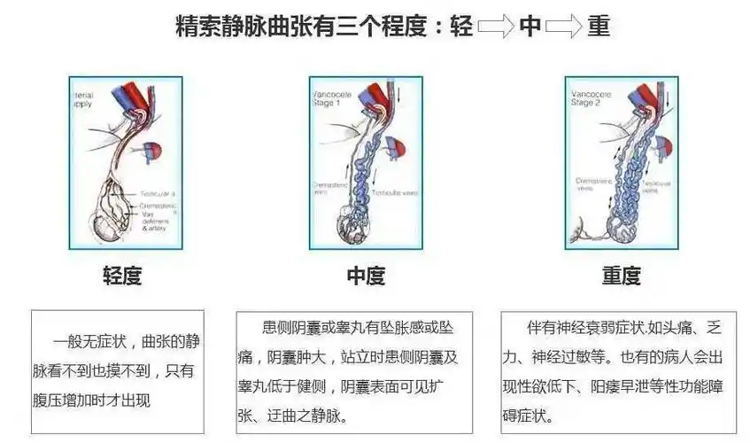 蛋蛋的忧伤你懂吗精索静脉曲张的手术治疗方式你有几种选择