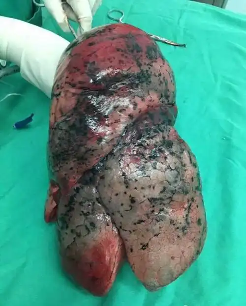 吸烟者的肺部,有图有真相.