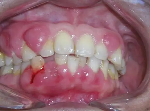 牙周病是侵犯牙龈和牙周组织的慢性炎症,是一种破坏性疾病,牙周病