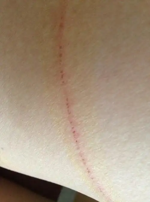 今天上午被自家狗狗的指甲抓破了皮,但是没有淌血,就看着红红的,不