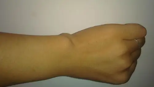 2014-01-30 陈小英 主治医师 手腕处这个骨头零八年骑电动车就不得劲