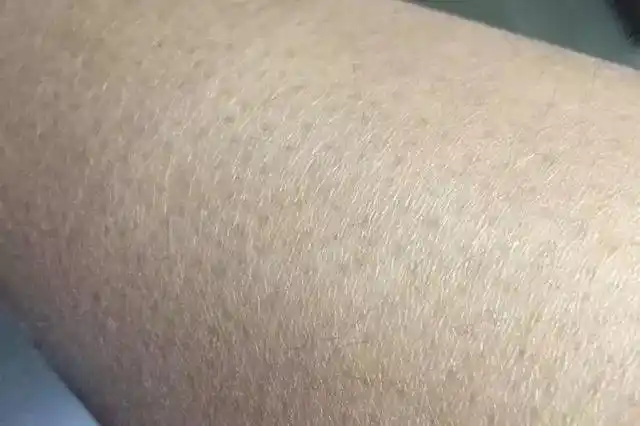 手臂长斑的原因是怎么引起的,身体长斑的原因是怎么引起的(女性长斑