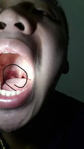 口腔里长了个小白点,在小舌头旁边,靠近喉咙的地方,有点类似于粉刺的