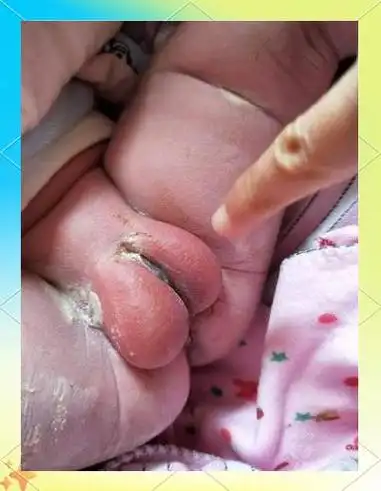 宝宝私处发红?5招教你轻松护理