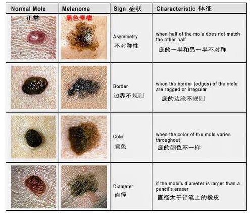 普通色素痣与黑色素瘤鉴别_痣_痣症状表现 - 好大夫在线