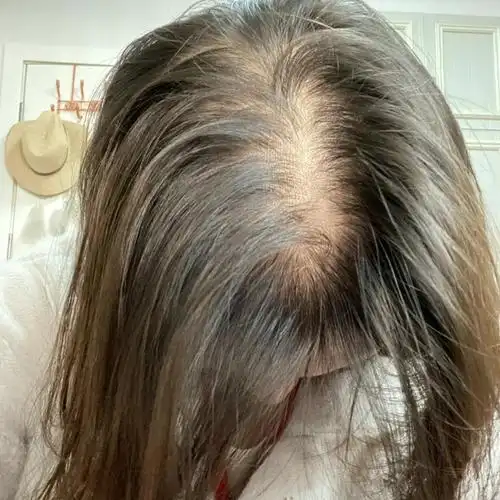 如何解决女生脱发